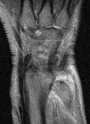 Figure 2 for case Ulnar impingement syndrome